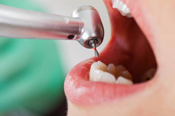Best Chipped Tooth Repair Near Me  in Brazoria, TX